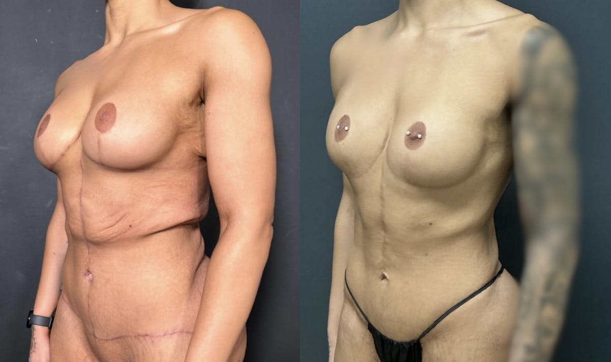 Fleur De Lis Abdominoplasty Before & After Gallery - Patient 134950 - Image 3