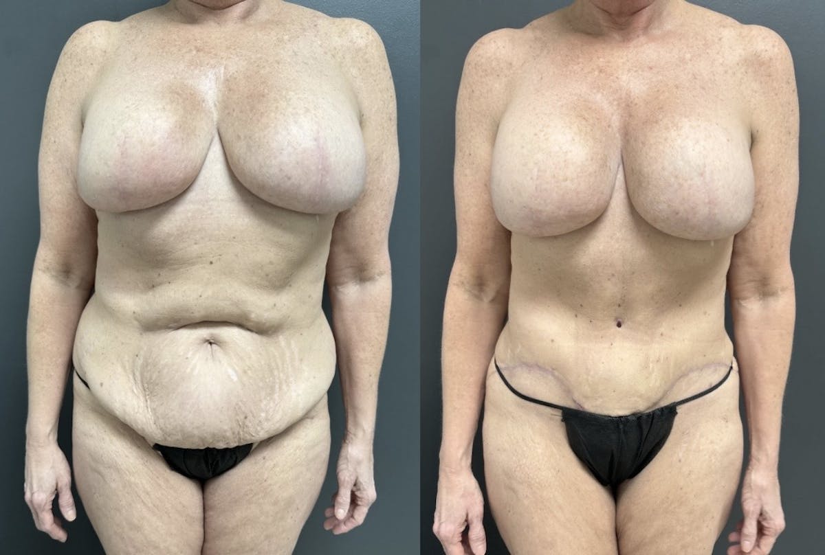 Abdominoplasty (Tummy Tuck) Before & After Gallery - Patient 170925 - Image 1