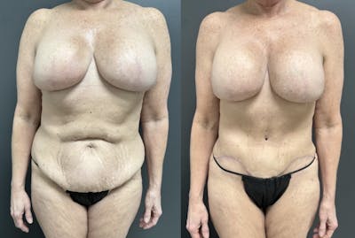 Abdominoplasty (Tummy Tuck) Before & After Gallery - Patient 170925 - Image 1
