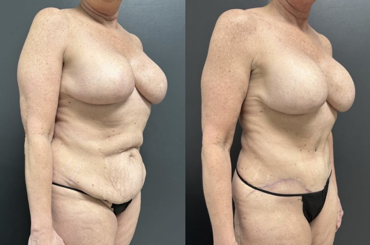 Abdominoplasty (Tummy Tuck) Before & After Gallery - Patient 170925 - Image 2