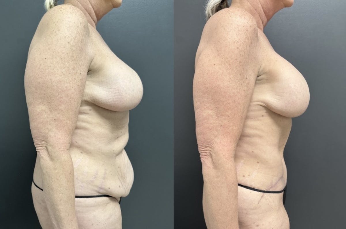Abdominoplasty (Tummy Tuck) Before & After Gallery - Patient 170925 - Image 3