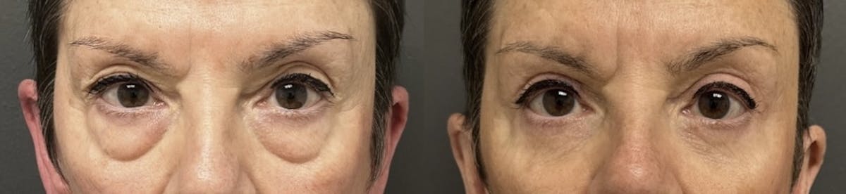Blepharoplasty Before & After Gallery - Patient 191878 - Image 1