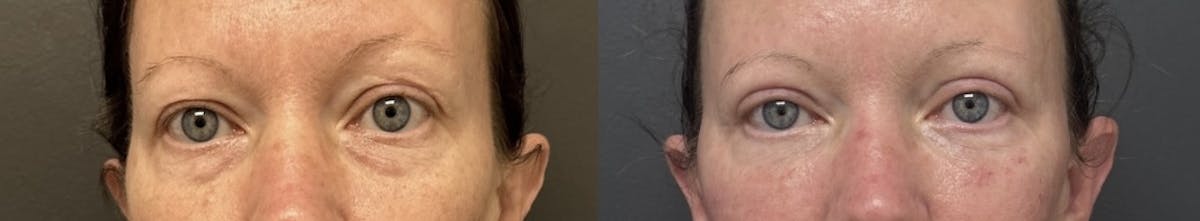 Blepharoplasty Before & After Gallery - Patient 332267 - Image 1