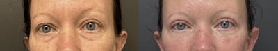 Blepharoplasty Before & After Gallery - Patient 332267 - Image 1