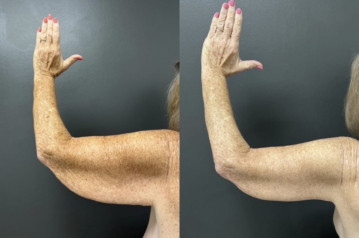 Brachioplasty (Arm Lift) Before & After Gallery - Patient 339686 - Image 1