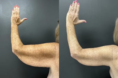 Brachioplasty (Arm Lift) Before & After Gallery - Patient 339686 - Image 1