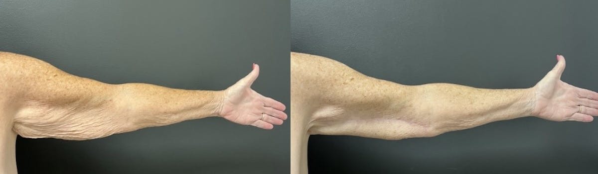Brachioplasty (Arm Lift) Before & After Gallery - Patient 339686 - Image 2