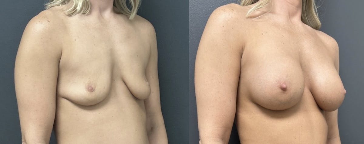 Breast Augmentation Before & After Gallery - Patient 356581 - Image 2