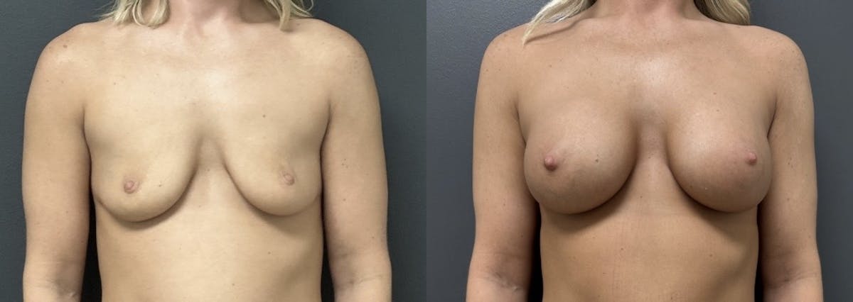 Breast Augmentation Before & After Gallery - Patient 356581 - Image 1