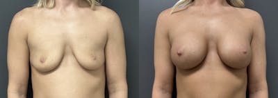 Breast Augmentation Before & After Gallery - Patient 356581 - Image 1