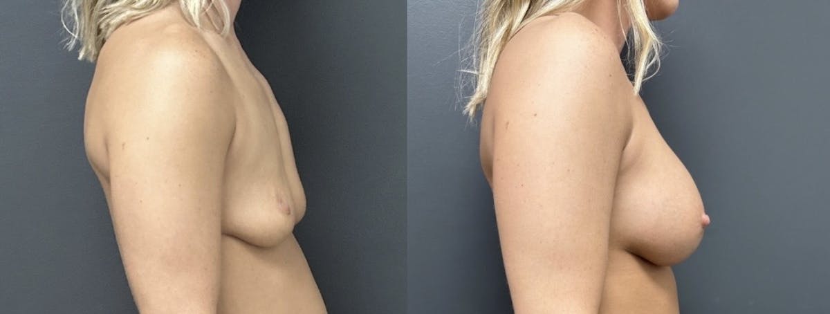 Breast Augmentation Before & After Gallery - Patient 356581 - Image 3