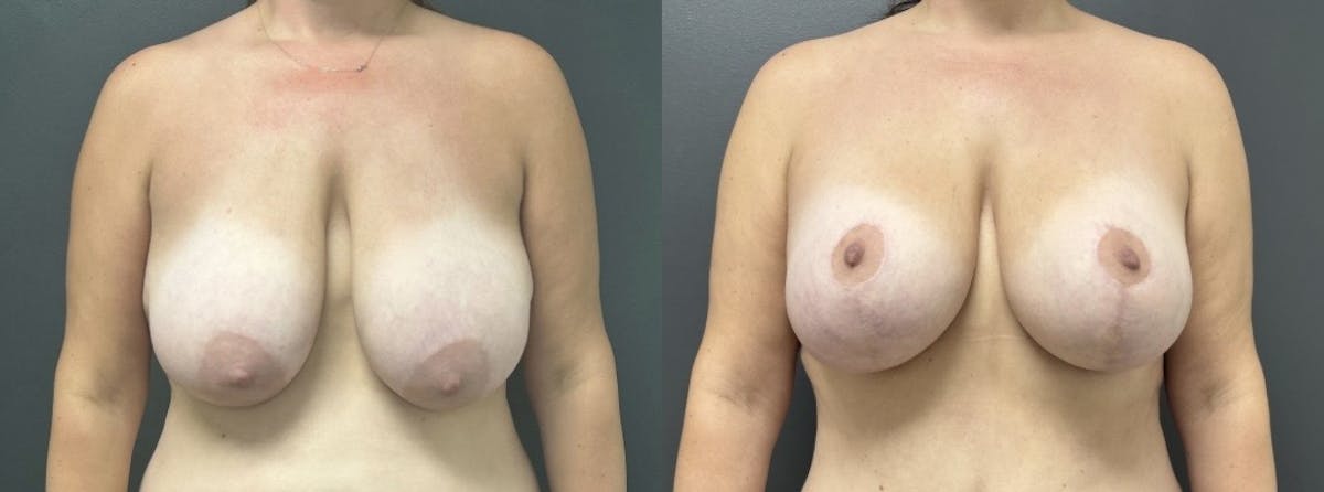 Breast Augmentation with Lift Before & After Gallery - Patient 427415 - Image 1