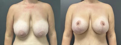 Breast Augmentation with Lift Before & After Gallery - Patient 427415 - Image 1