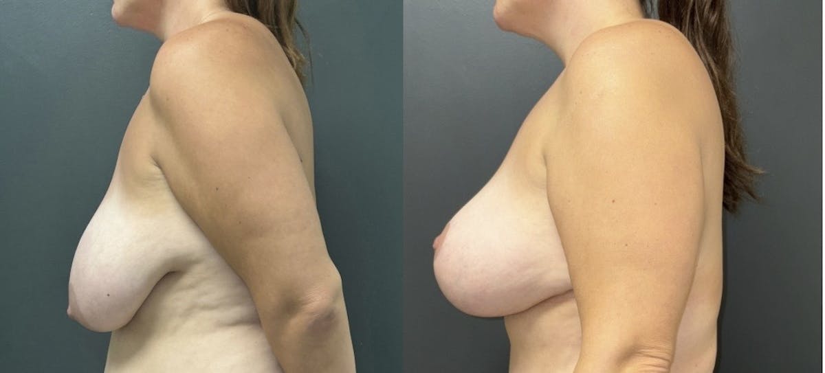 Breast Augmentation with Lift Before & After Gallery - Patient 427415 - Image 3