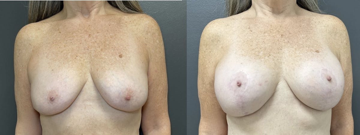 Breast Augmentation with Lift Before & After Gallery - Patient 328951 - Image 1
