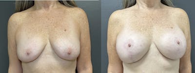 Breast Augmentation with Lift Before & After Gallery - Patient 328951 - Image 1