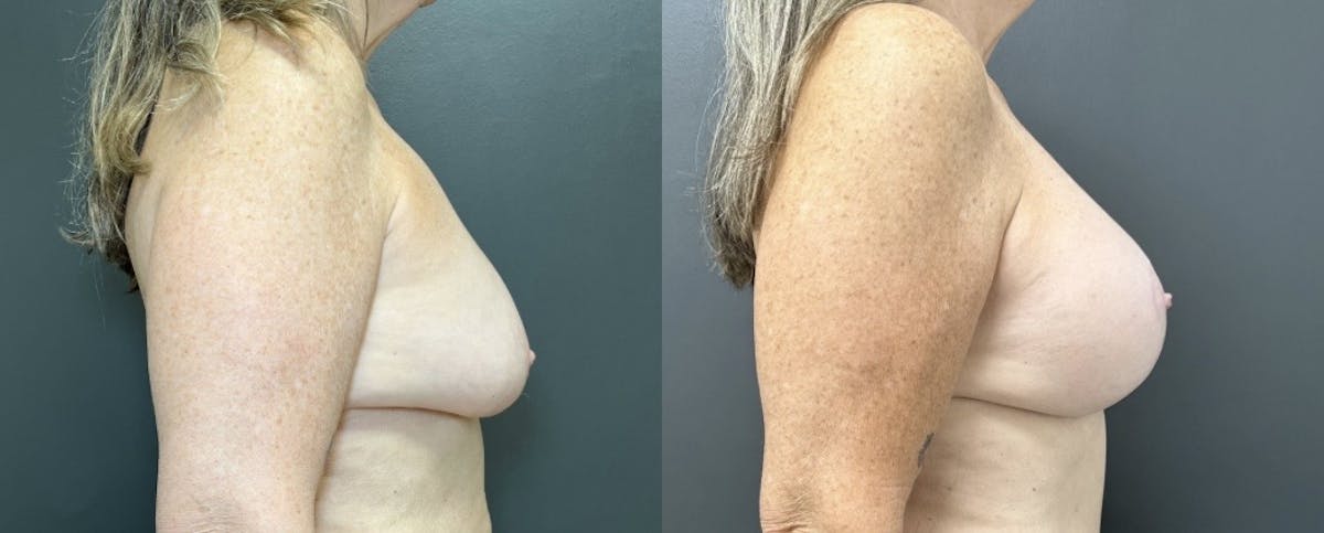 Breast Augmentation with Lift Before & After Gallery - Patient 328951 - Image 3