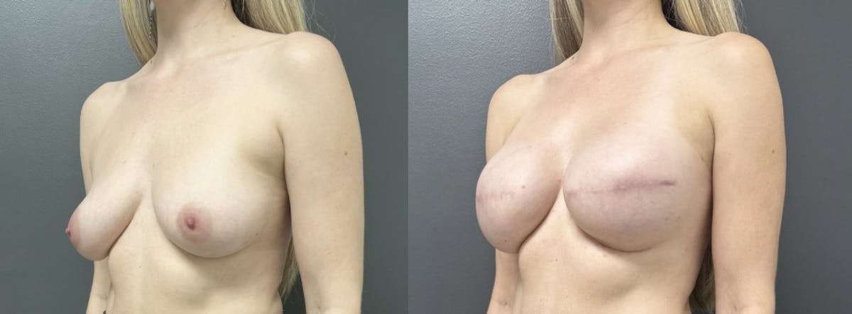 Breast Reconstruction Before & After Gallery - Patient 275910 - Image 2