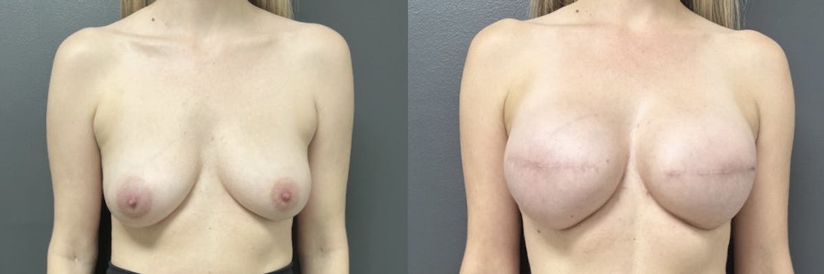 Breast Reconstruction Before & After Gallery - Patient 275910 - Image 1