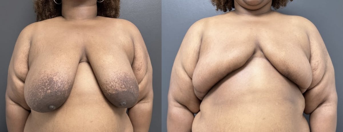 Breast Reconstruction Before & After Gallery - Patient 142889 - Image 1