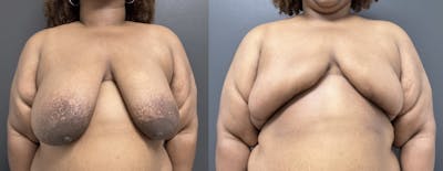 Breast Reconstruction Before & After Gallery - Patient 142889 - Image 1