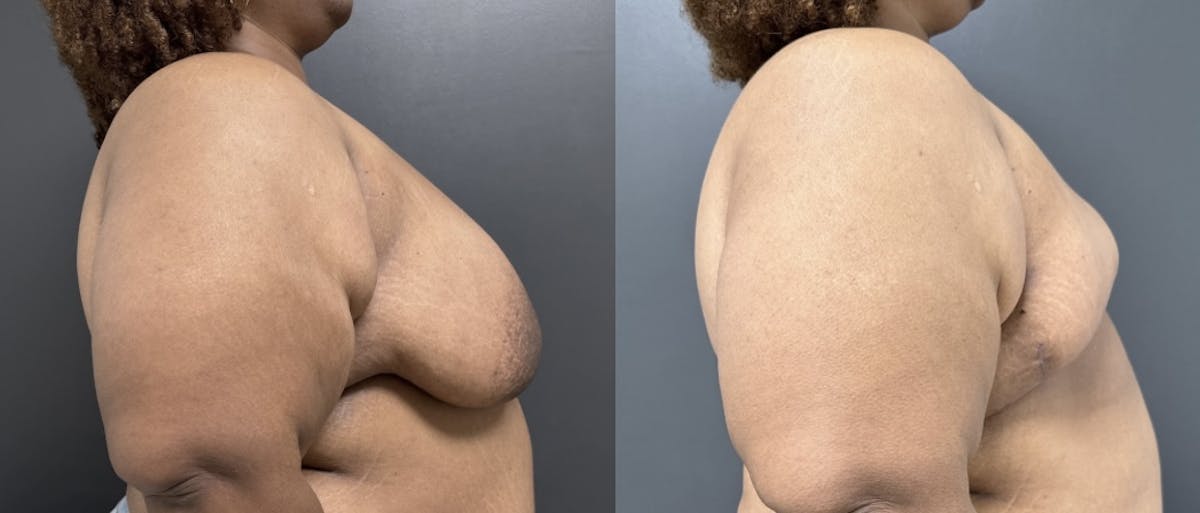 Breast Reconstruction Before & After Gallery - Patient 142889 - Image 2
