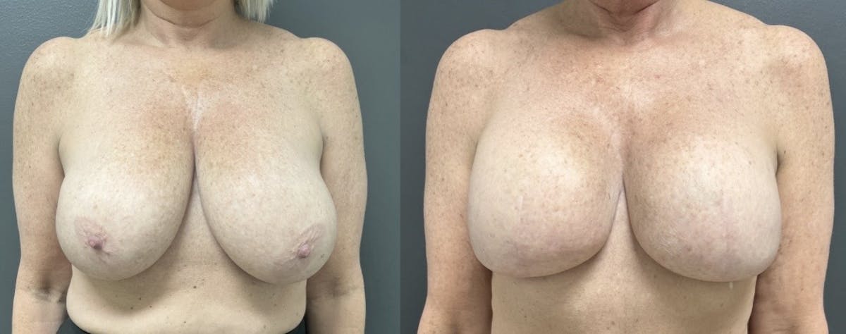 Breast Reconstruction Before & After Gallery - Patient 157942 - Image 1