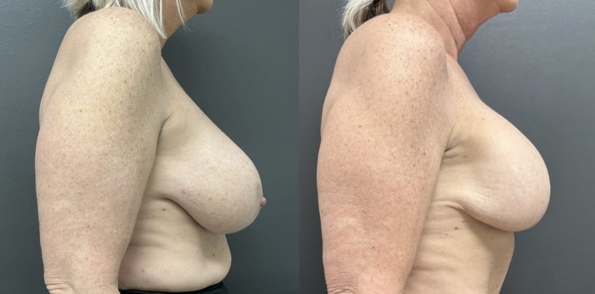 Breast Reconstruction Before & After Gallery - Patient 157942 - Image 3