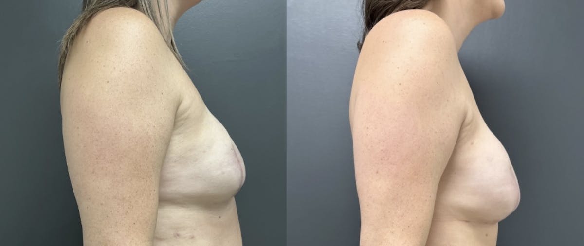 Breast Reconstruction Before & After Gallery - Patient 889077 - Image 3