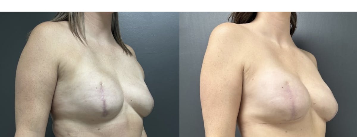 Breast Reconstruction Before & After Gallery - Patient 889077 - Image 2