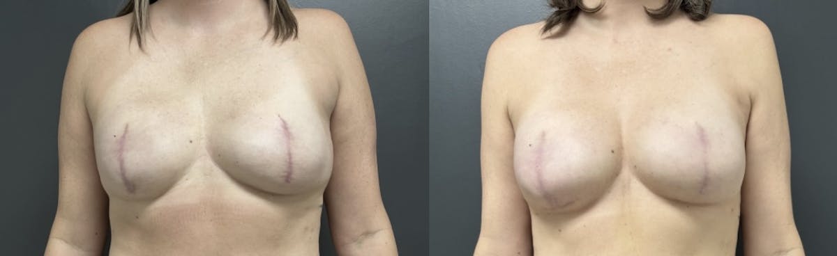 Breast Reconstruction Before & After Gallery - Patient 889077 - Image 1