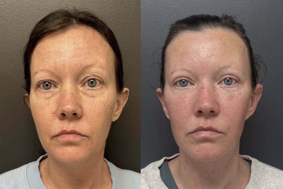 Facial Fat Grafting Before & After Gallery - Patient 692078 - Image 1