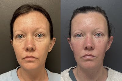 Facelift Before & After Gallery - Patient 299708 - Image 1