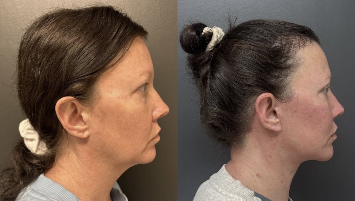Facelift Before & After Gallery - Patient 299708 - Image 3