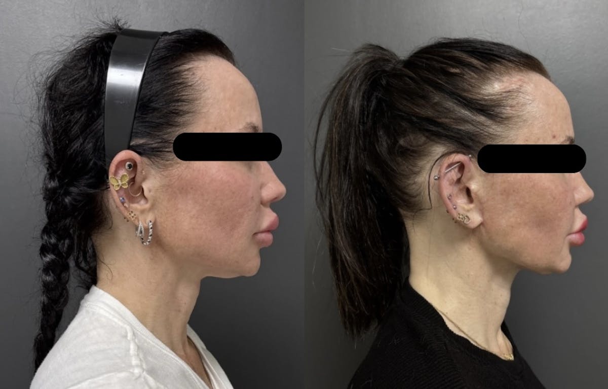 Facelift Before & After Gallery - Patient 412660 - Image 1