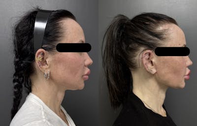 Facelift Before & After Gallery - Patient 412660 - Image 1