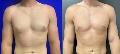 Gynecomastia Before & After Gallery - Patient 321967 - Image 1