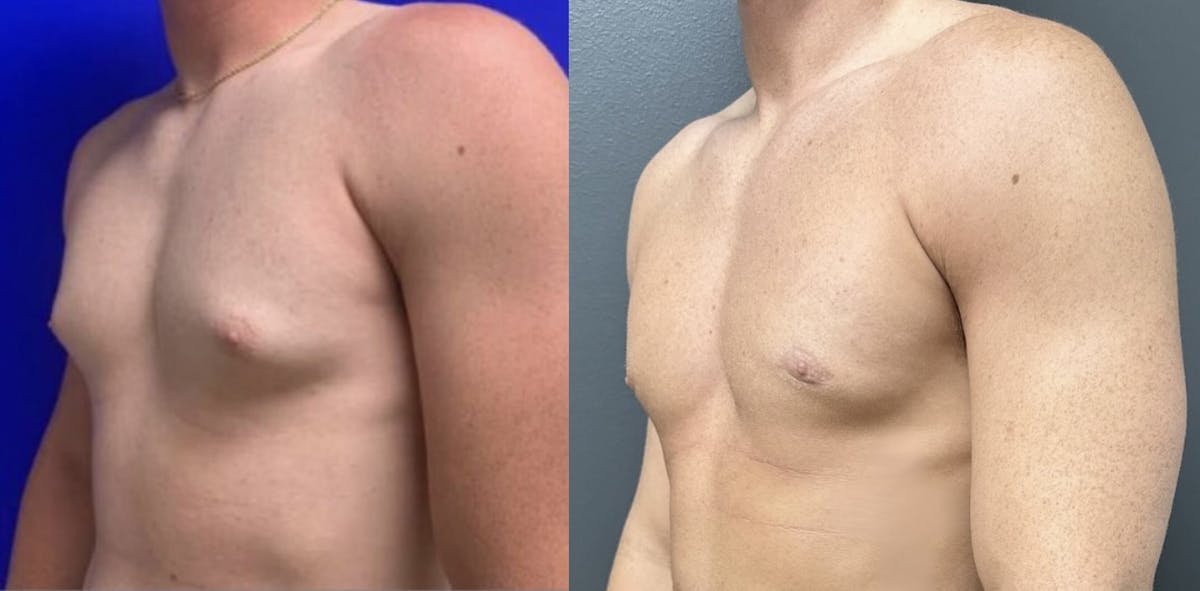 Gynecomastia Before & After Gallery - Patient 321967 - Image 2