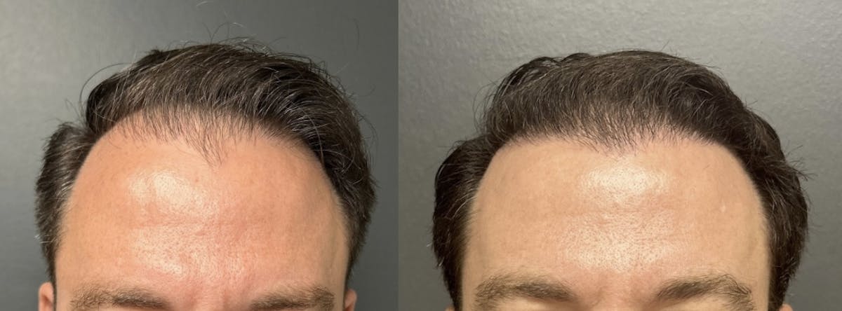 Hair Transplant Before & After Gallery - Patient 161233 - Image 1
