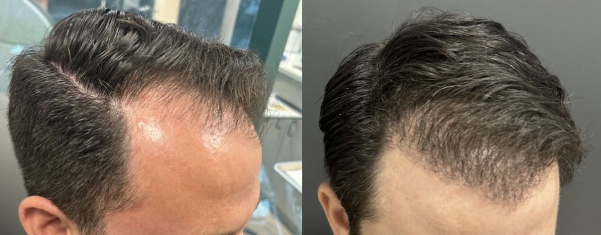 Hair Transplant Before & After Gallery - Patient 161233 - Image 2