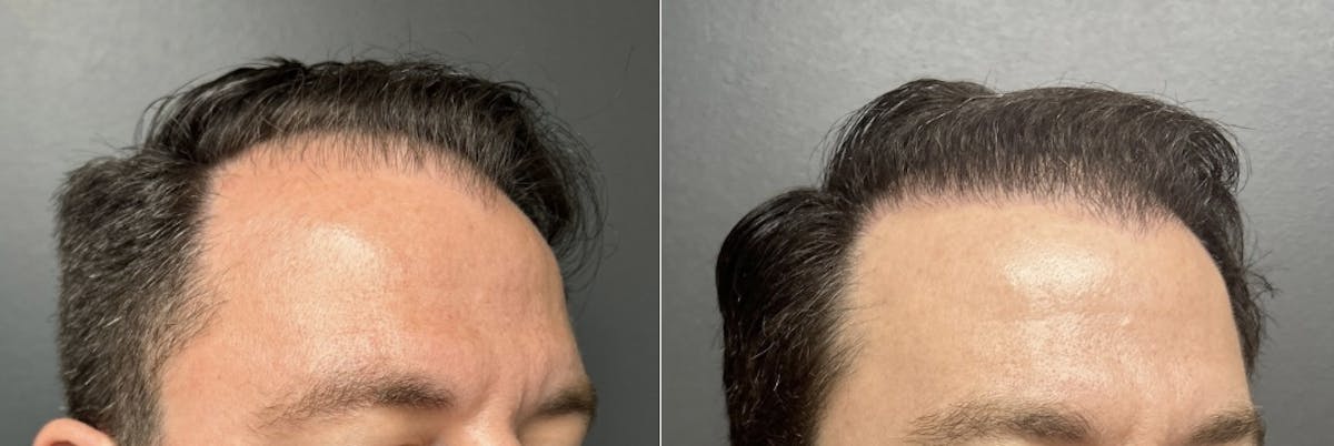 Hair Transplant Before & After Gallery - Patient 161233 - Image 3