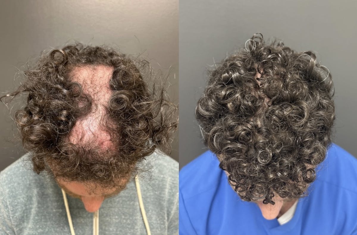 Hair Transplant Before & After Gallery - Patient 176216 - Image 1