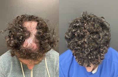Hair Transplant Before & After Gallery - Patient 176216 - Image 1