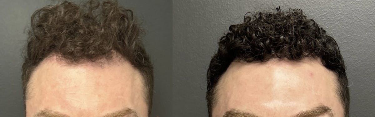 Hair Transplant Before & After Gallery - Patient 176216 - Image 2