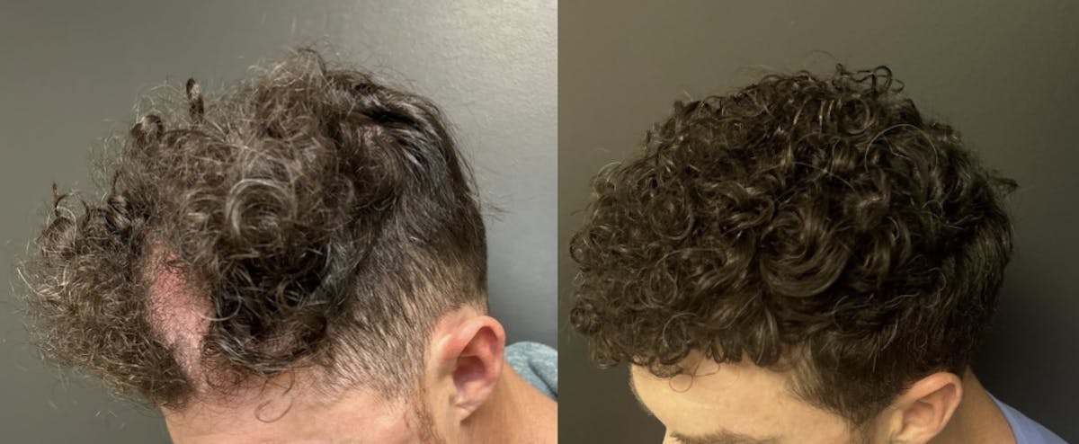 Hair Transplant Before & After Gallery - Patient 176216 - Image 3