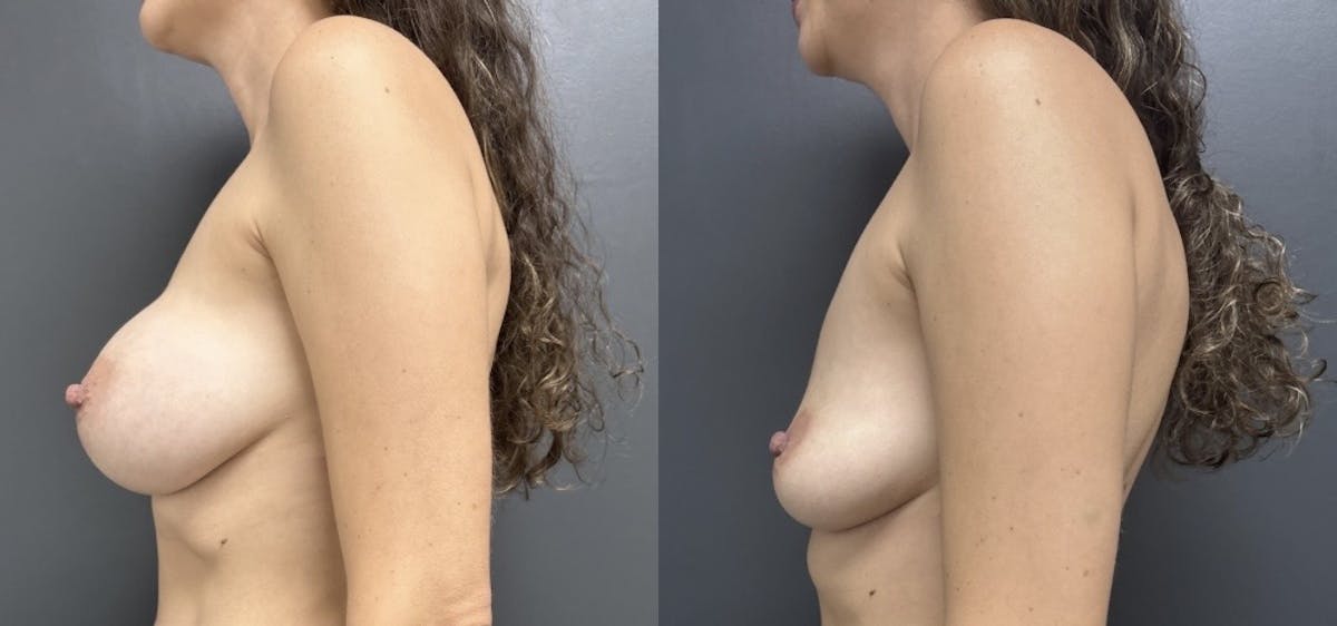Breast Implant Removal Before & After Gallery - Patient 254157 - Image 3