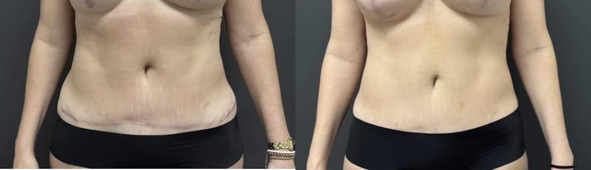Liposuction Before & After Gallery - Patient 177591 - Image 1