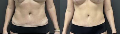 Liposuction Before & After Gallery - Patient 177591 - Image 1