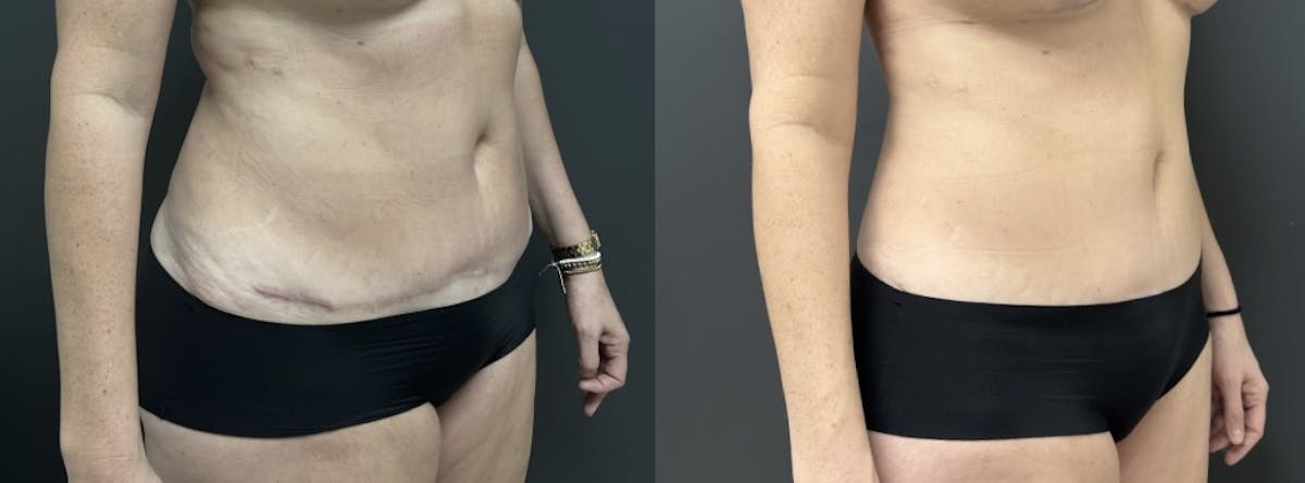 Liposuction Before & After Gallery - Patient 177591 - Image 2