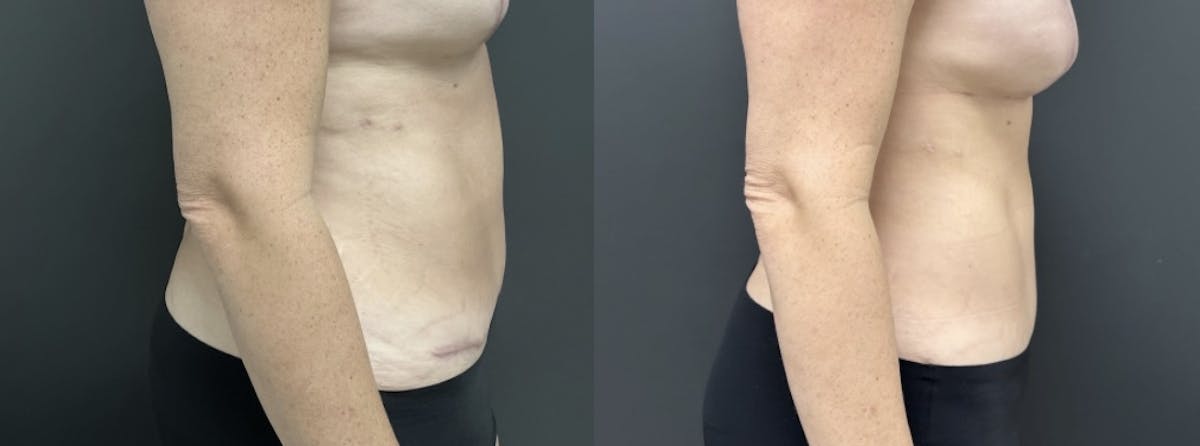 Liposuction Before & After Gallery - Patient 177591 - Image 3